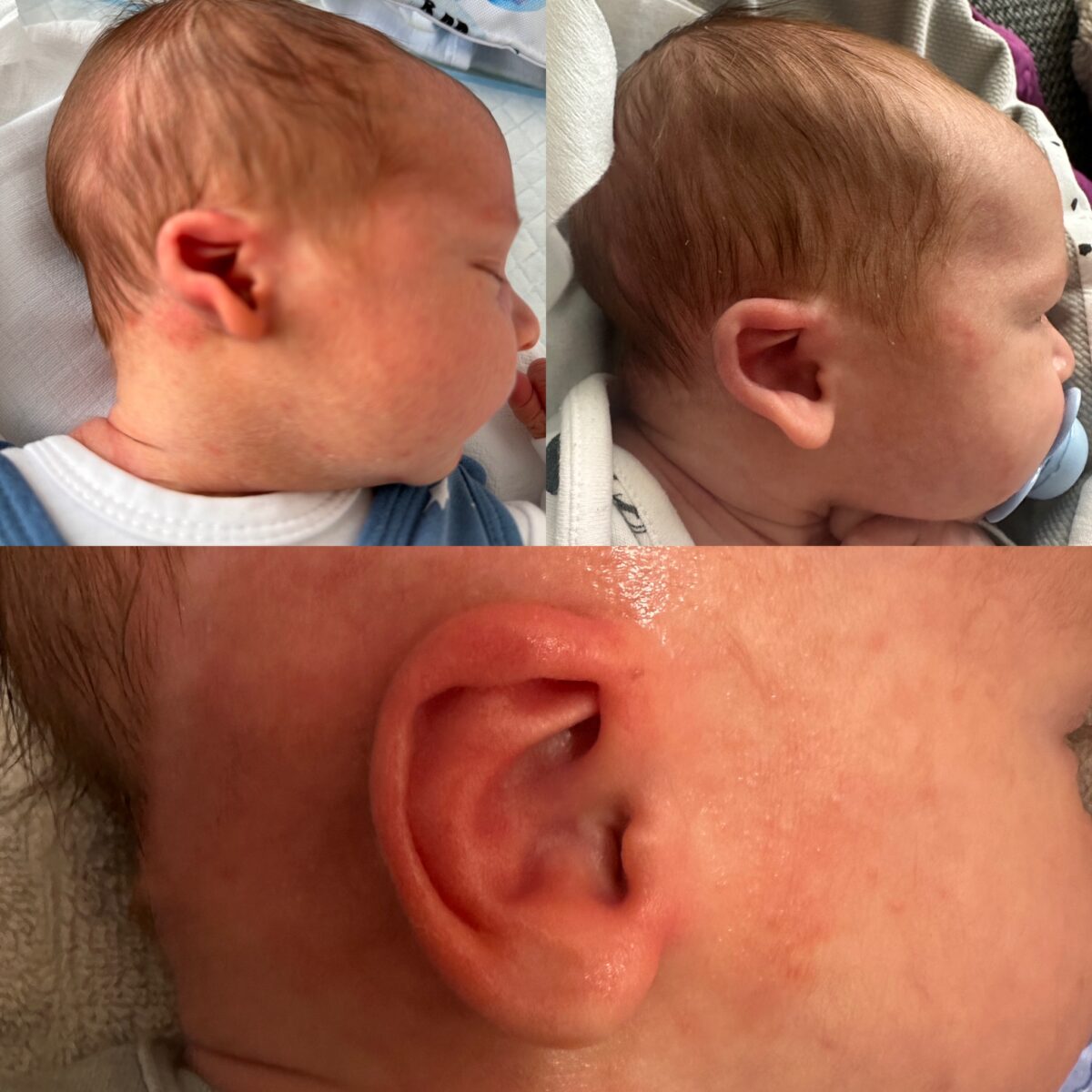 Odstáré boltce, kornoutovité ucho, constricted ear, po léčbě EarWell systémem - Pred a po léčbě